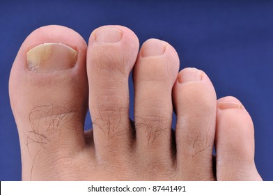 Right Foot Toe Nail Suffering From Fungus Infection