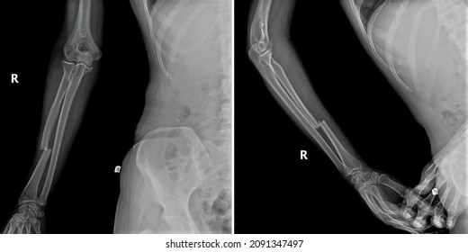 Right forearm.Displaced radius fracture  AP and Lateral radiography, x ray.Ulna is intact. - Shutterstock ID 2091347497