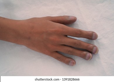 Right Hand Of Patient With Congenital Cyanotic Heart Disease On White Background. Typical Characteristic For Clubbing Fingers. Focus On The Fingers.