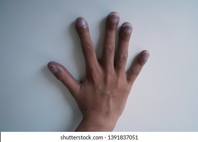 Right Hand Of Patient With Congenital Cyanotic Heart Disease On White Background. Typical Characteristic For Clubbing Fingers. Focus On Fingers.