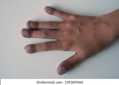 Right Hand Of Patient With Congenital Cyanotic Heart Disease On White Background. Typical Characteristic For Clubbing Fingers. Focus On Fingers.