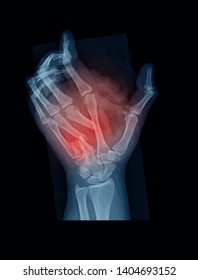 Film Xray Index Finger Hand Point Stock Photo (Edit Now) 386325379