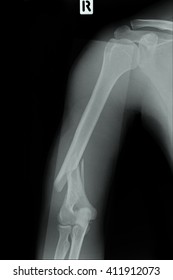 Right Humerus Fracture