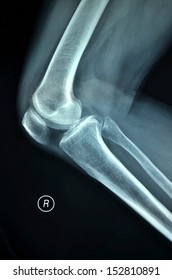 Right knee joint X-ray photos, lateral position