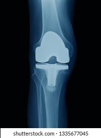 Right Knee Replacement Xray Image Anteroposterior Stock Photo 