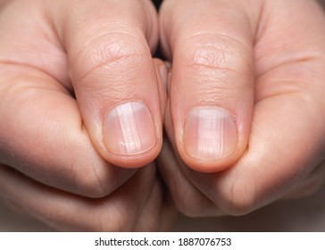 Right and left hand showing ridged nails on thumbs. Caucasian woman, short cut nails.
