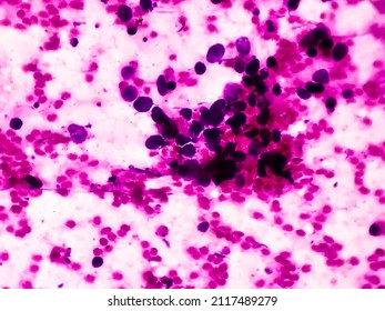 Right Lung Mass MRI  Guaided FNA Microscopic Show Positive For Malignant Cell, Small Cell Carcinoma.