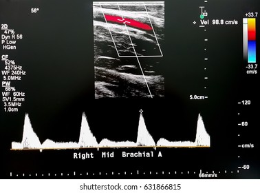 Right Middle Brachial Artery