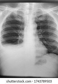 Right Pleural Effusion With Intraabdominal Lymphoma.