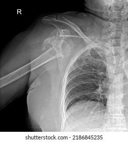 Right Shoulder Dislocation AP Radiograph 