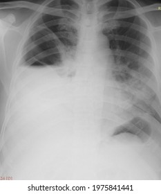 Right  Thoracic Empyema .lung Disease 