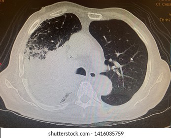 Right Upper Lung Infiltration In CT Scan, Lung Mass, Lung Window