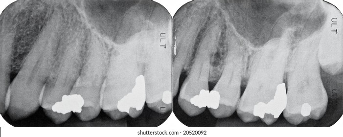 Right Upper Periodontal X-rays