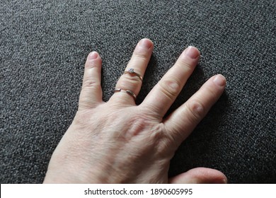 Ring Stuck And Cut On Adult Finger