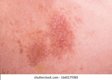 Ring Worm Infection, Dermatophytosis On Asian Skin