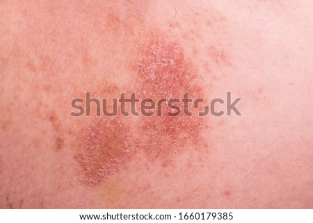 Ring worm infection, dermatophytosis on asian skin