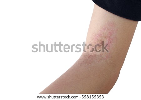 Ring Worm infection, Dermatophytosis on skin
