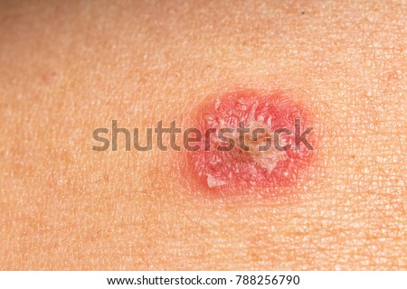 Ring Worm infection, Dermatophytosis on skin