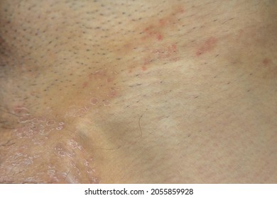 Ring Worm Infection On Skin, Itching In The Groin