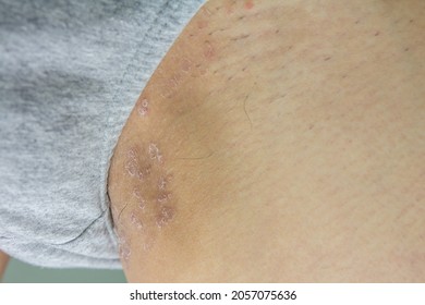 Ring Worm Infection On Skin, Itching In The Groin