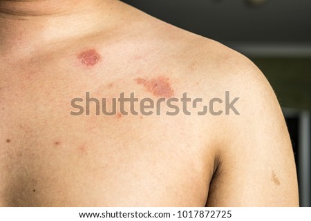 Ringworm or Dermatophytosis on the body. It is caused by a fungus