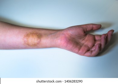 Ringworm On Arm With Hand