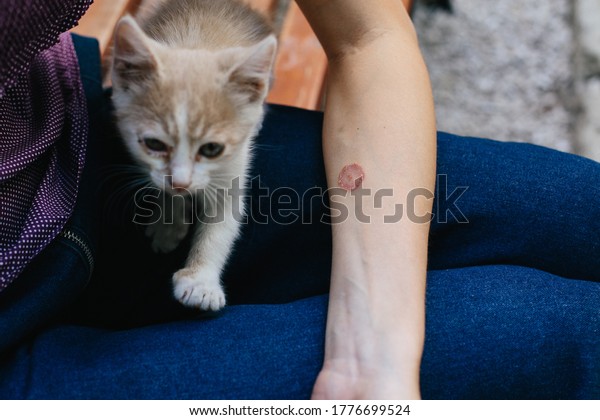 Ringworm on\
Arm with Hand. Cat disease. Skin\
problem