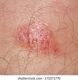 Ringworm Of The Skin. Macro