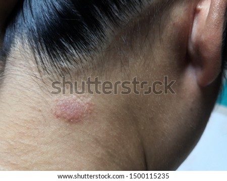 Ringworm (tinea) on head of asian woman (Dermatitis),Ring Worm infection, Dermatophytosis on skin.