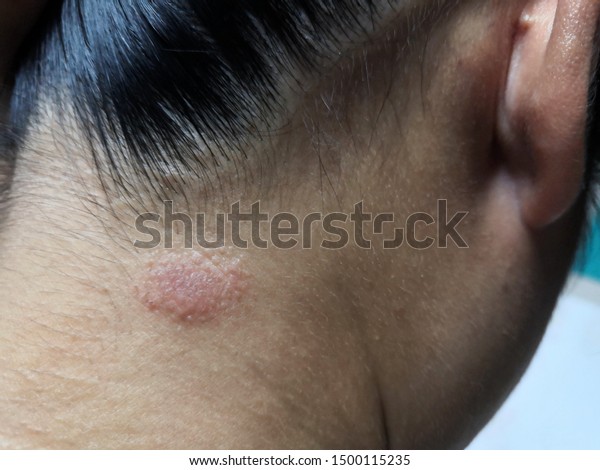 Ringworm Tinea On Head Asian Woman Stock Photo (Edit Now) 1500115235