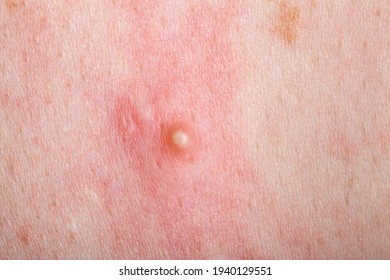 ripe pimple on the inflamed reddened skin of a person close-up, problem dry skin with an inflammatory rash.