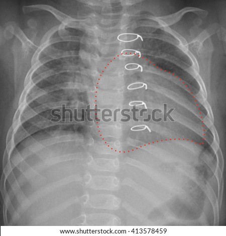 Roentgenogram Chest Child After Cardiac Surgery Stock ...