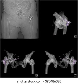 Roentgenogram and CT images of a hip fracture after surgery