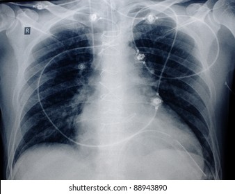 Roentgenogram Of Patient's Chest After Cardiac Surgery. Visible Wire Joints, Electrodes, Venous Catheter, Endotracheal Tube.