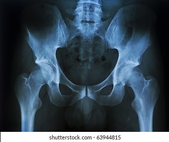 Rontgen Picture Of Male Pelvis