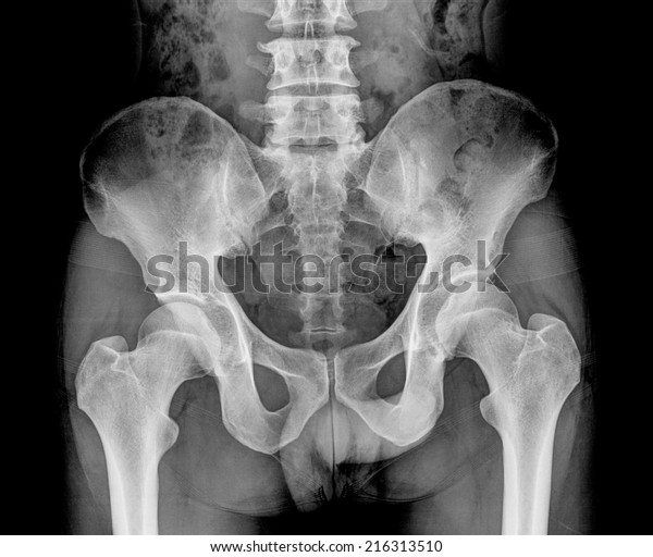 Rontgen Picture Male Pelvis Sacroiliac Joint 库存照片 立即编辑 216313510