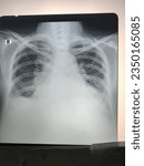 a rontgen thorax patient who diagnose congestion heart failure and efusion right pleura