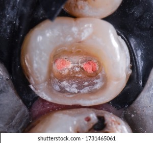 Root Canal Treatment Under Microscope