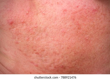 Rosacea Skin Disease On The Face