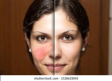 Rosacea Treatment, Woman Face Before And After