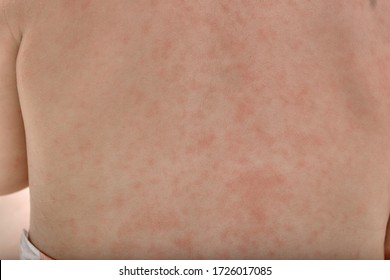 Roseola Rash A Viral Rash On The Skin Of A Child