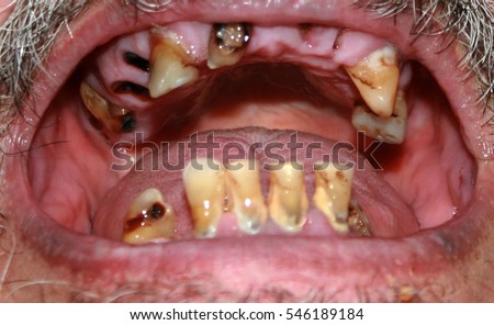rotten bad teeth beard mustache caries stock photo edit now