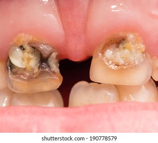 Rotten Teeth. Macro