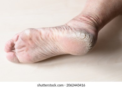 Rough Cracked Skin On Heel Of Male Foot Close Up