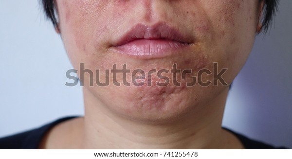 皮脂で塞がれた 炎症性にざ瘡による顎の周りの肌荒れは 皮膚科で治す必要がある アジアの女性は 皮膚 赤いコメドン 炎症性ニキビ 大きな毛穴 赤いニキビ病変がある の写真素材 今すぐ編集