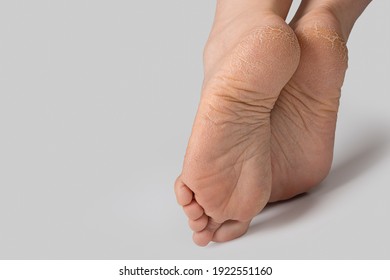 rough skin on female feet on grey background. Dry and cracked soles of feet on white background, womans feet with dry heels, cracked skin. Foot treatment concept