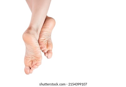 rough skin on soles of feet. dry heels, dry chapped skin on feet requiring care isolated on white background, dry skin on heels and soles needs care. copy space