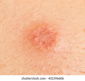 Ring Worm Infection Dermatophytosis On Skin Stock Photo 788256790 ...