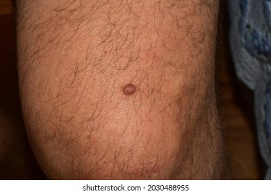 Round Papilloma On The Knee Of A Man.