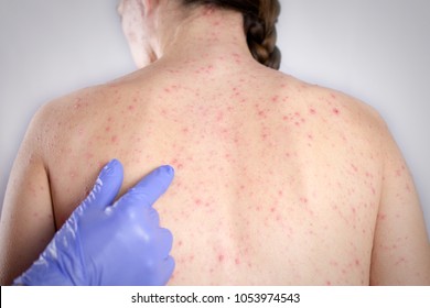  Rubella Concept. Girls Back Skin Bubble Rash